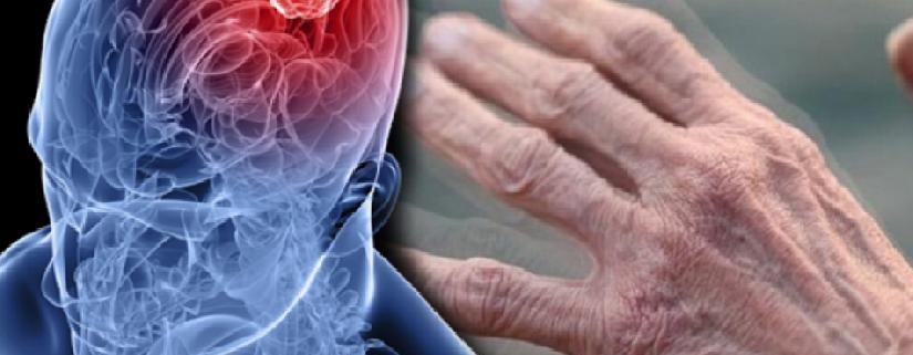 Parkinson Hastalığı Nedir Parkinsonun Belirtileri Nelerdir Parkinson Nasıl Tedavi Edilir 4007